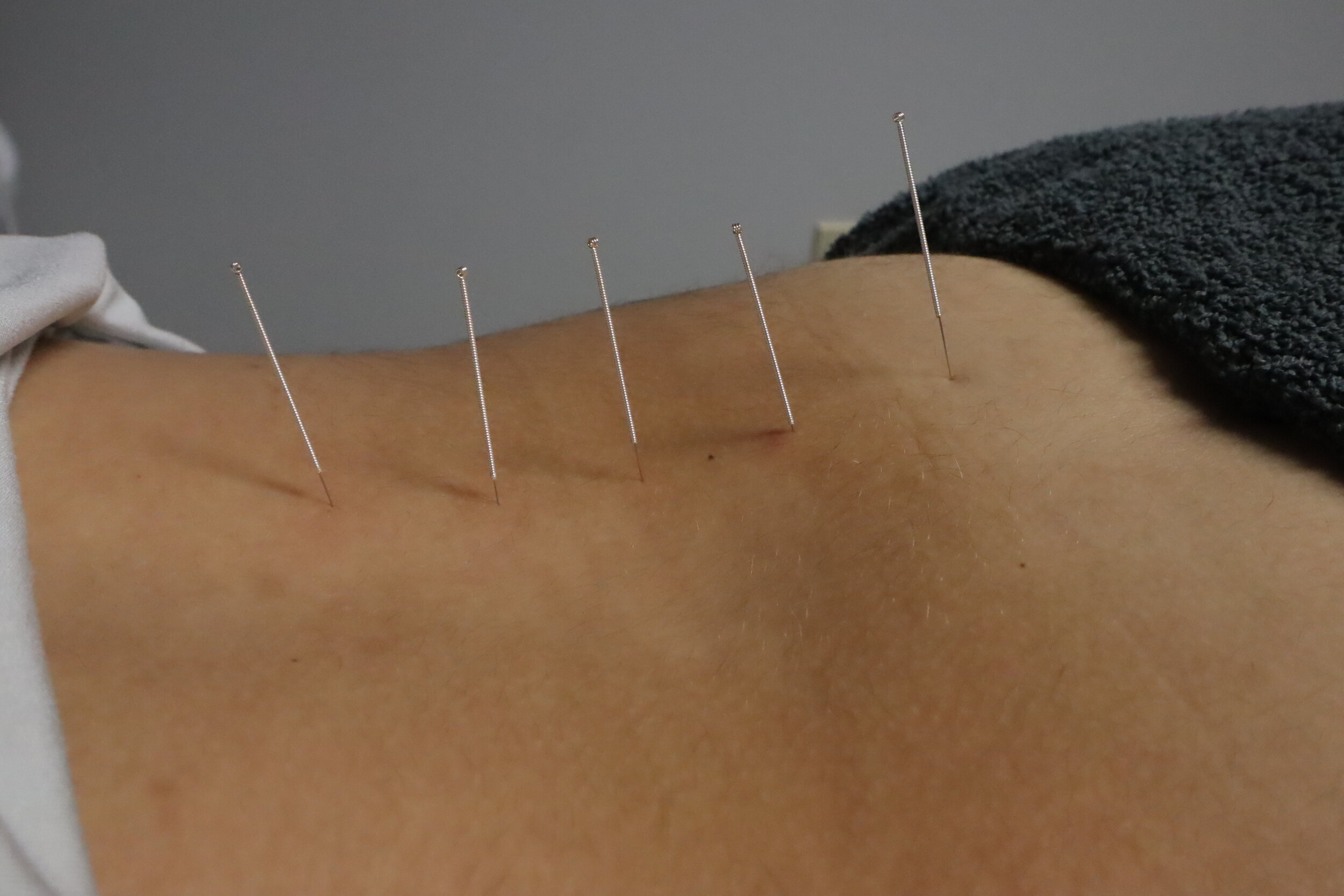 Needles in Low Back.jpg