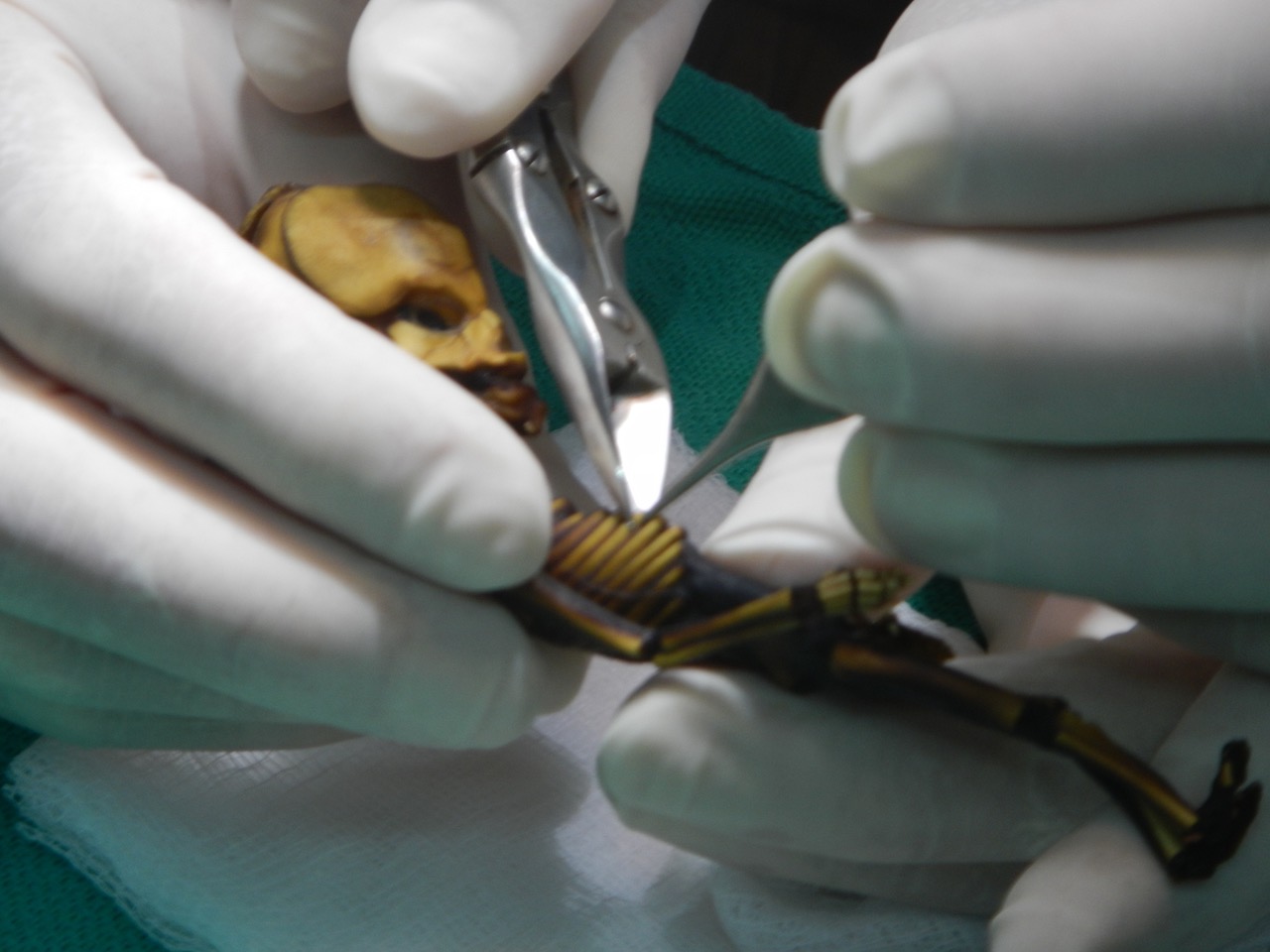 Clipping Ribs To Extract Bone Marrow