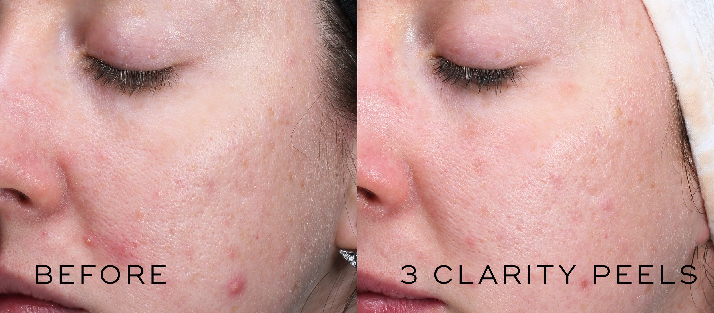 Copy of 3 Clarity Peels B&A.jpg