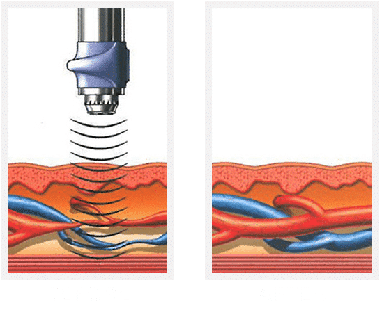 Increase of Blood Flow Through Revascularization