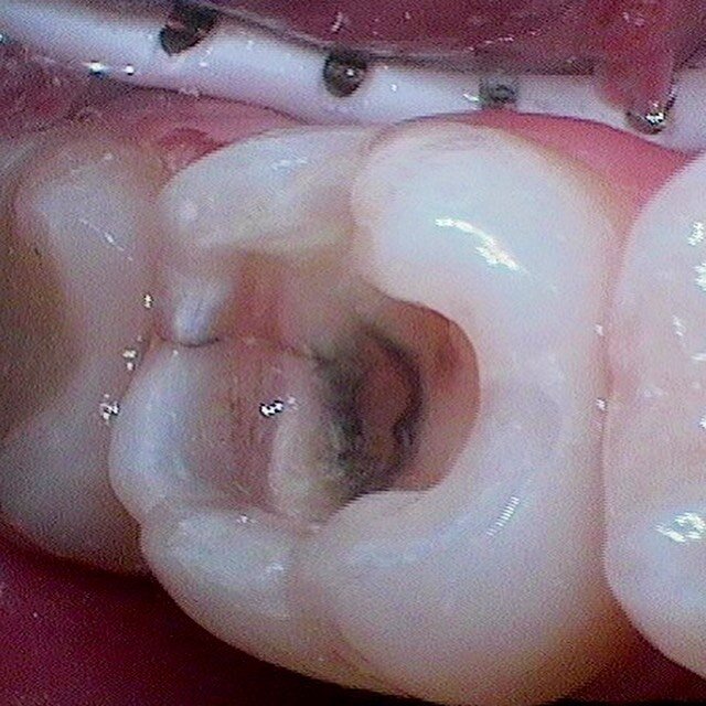 #fracturedtooth This patient came to us with pain while chewing. After removing the existing filling from his tooth this fracture line can clearly be seen running towards the pulp of the tooth. All decay was removed and the tooth temporarily restored