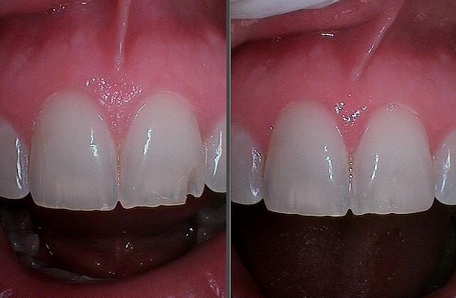 Quick fix of the day! Little chips in your enamel can look bad, but are easy to repair. Look what we did in 10 minutes for this patient!
#dentistrylife #chicagodentist #chippedtooth #millenniumpark #thebean #michiganave #cosmeticdentistry