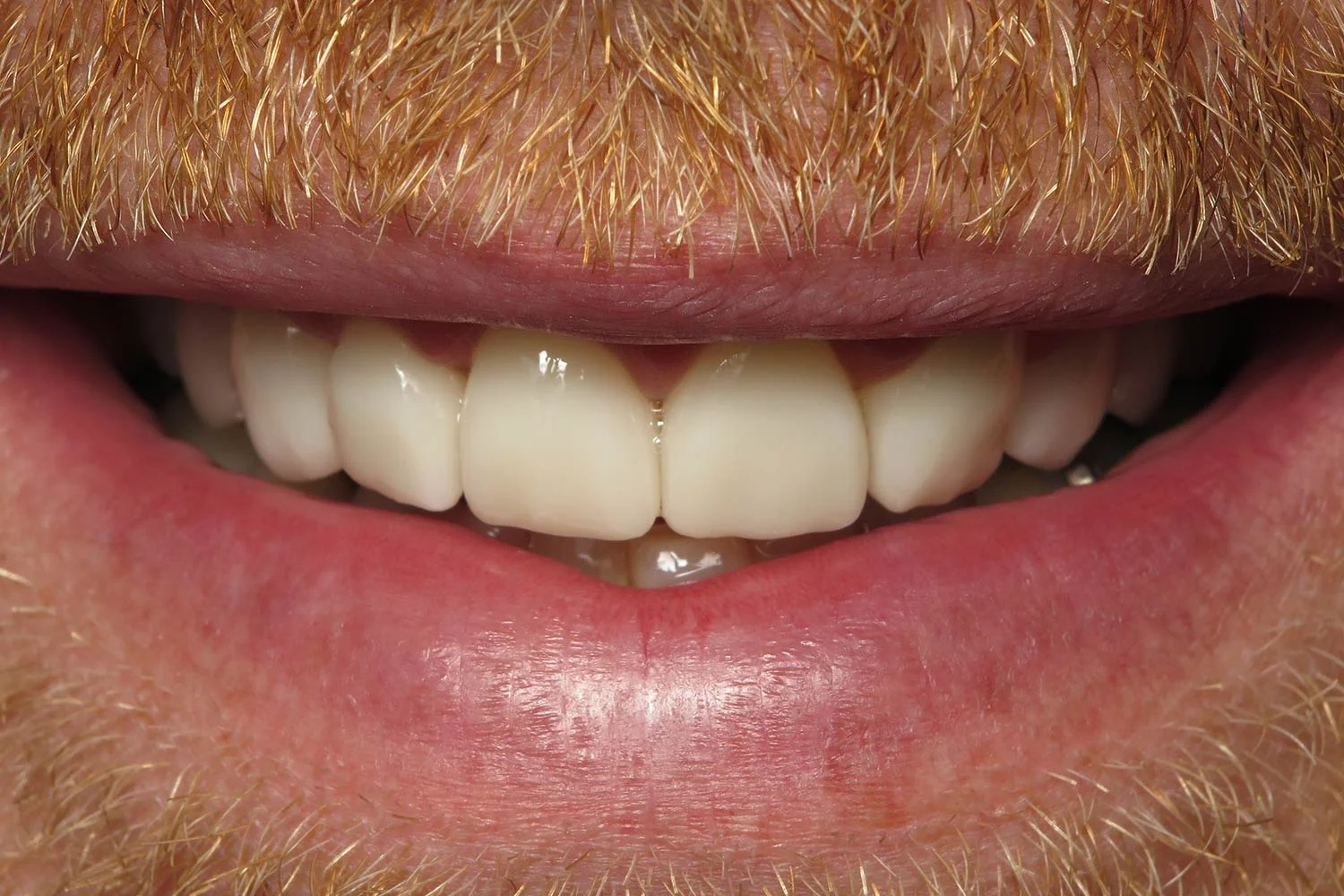 Adam-Greenquist_-full-arch-rehab_after.jpg