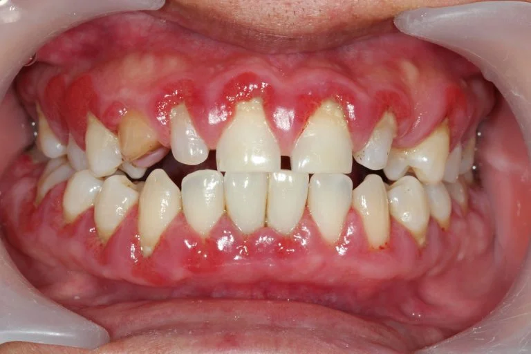 Receive Several Types of Gingivitis Treatment in Lincoln.jpg