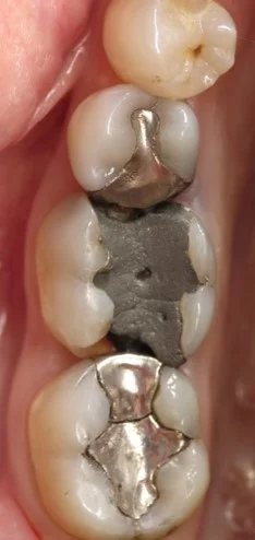 Dental Fillings 1.jpg
