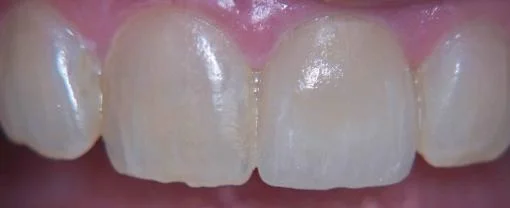 After Cerec Tooth Repair.jpg