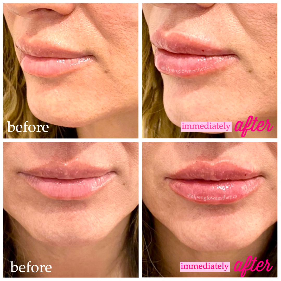 Before after lips 1.PNG