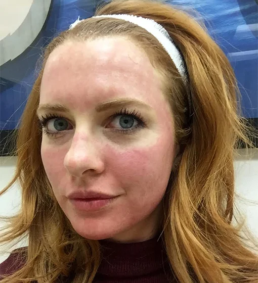 I Got a Blood Facial and Lived to Tell the Tale