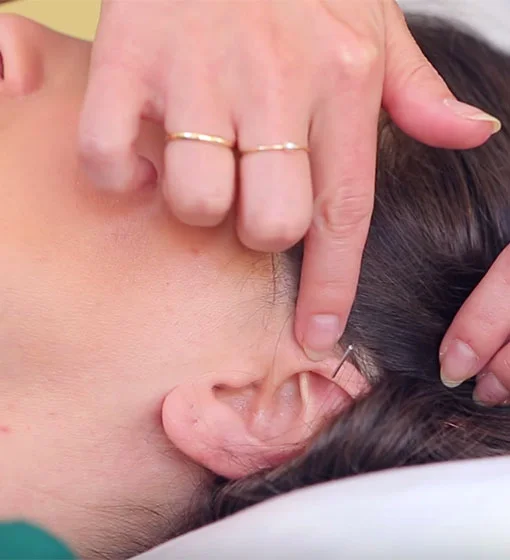 An Acupuncture Morning Sickness Remedy