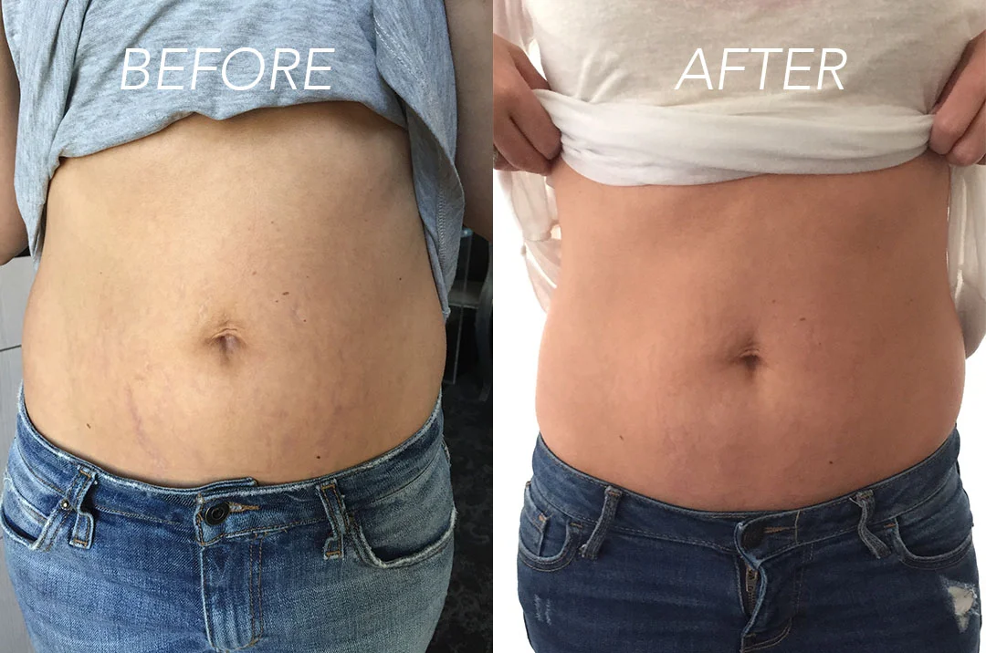 This Stretch Mark Removal Treatment Really Works!