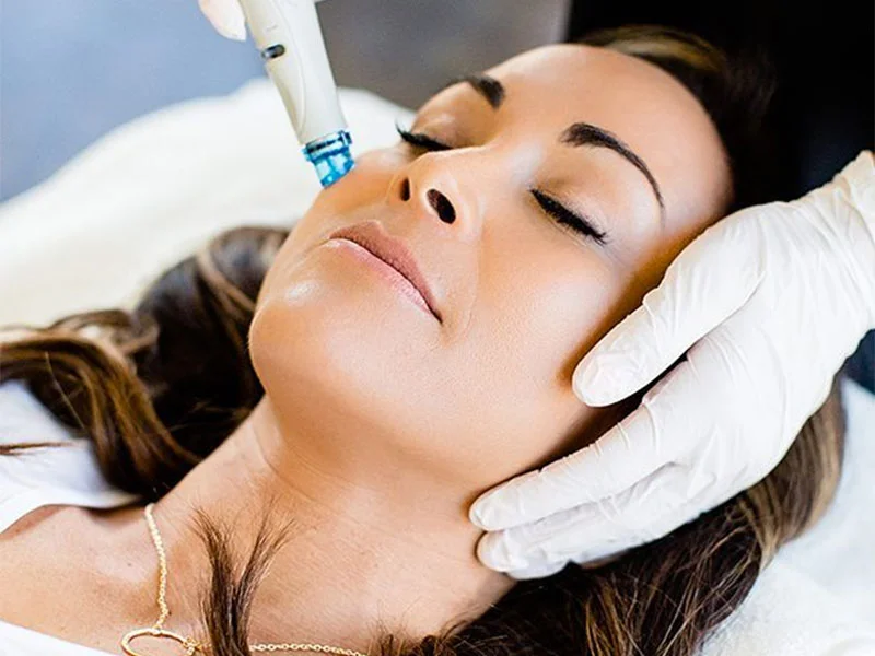 How This Celeb-Faved Facial Erased My Smile Lines in 30 Minutes