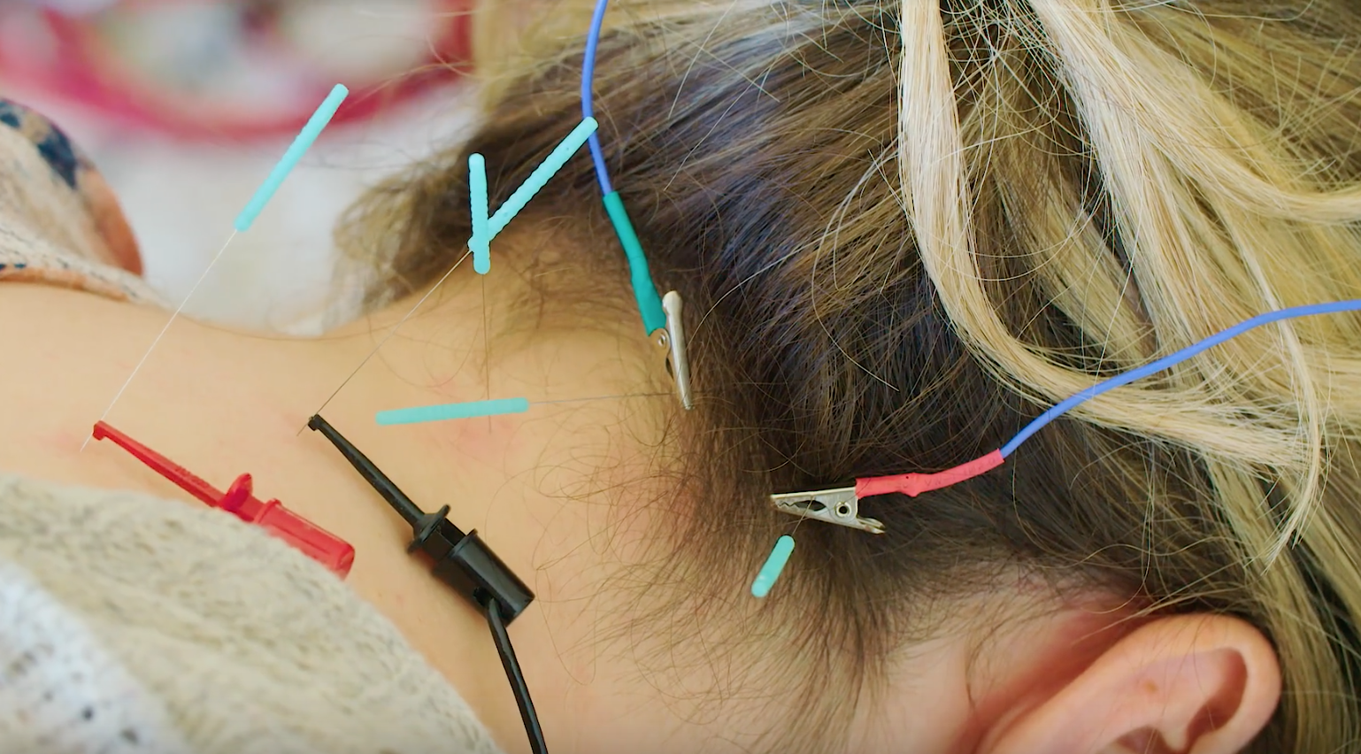 Take Your Acupuncture to the Next Level with Electro Acupuncture
