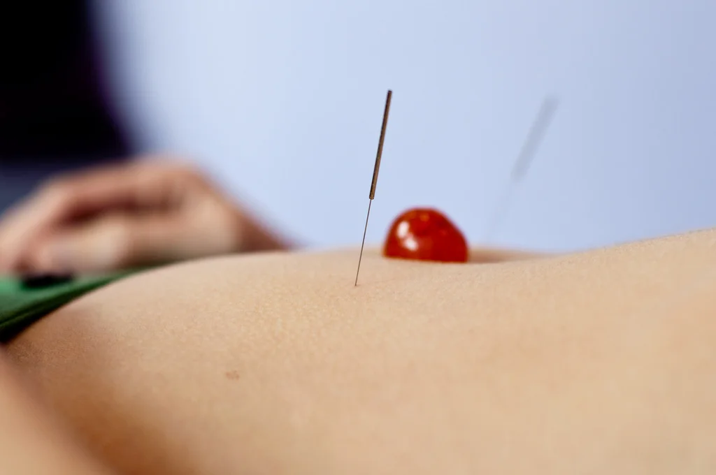 acupuncture-flickr.jpg