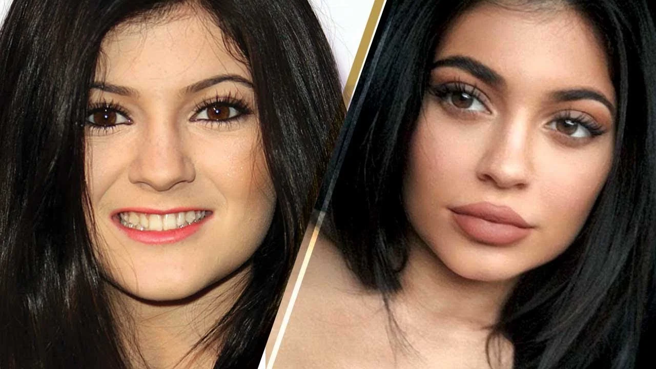 Kylie Jenner's Lips: How To Remove Filler