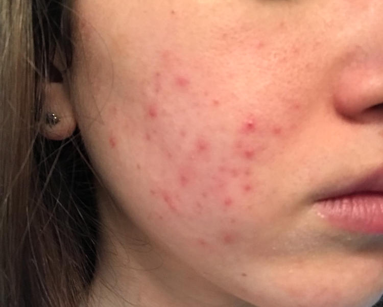 can b12 injection cause spots Acne and Vitamin B12