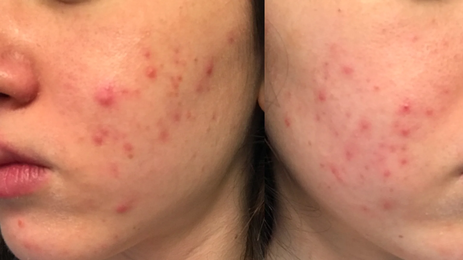 Did Vitamin B12 Give Me Acne?