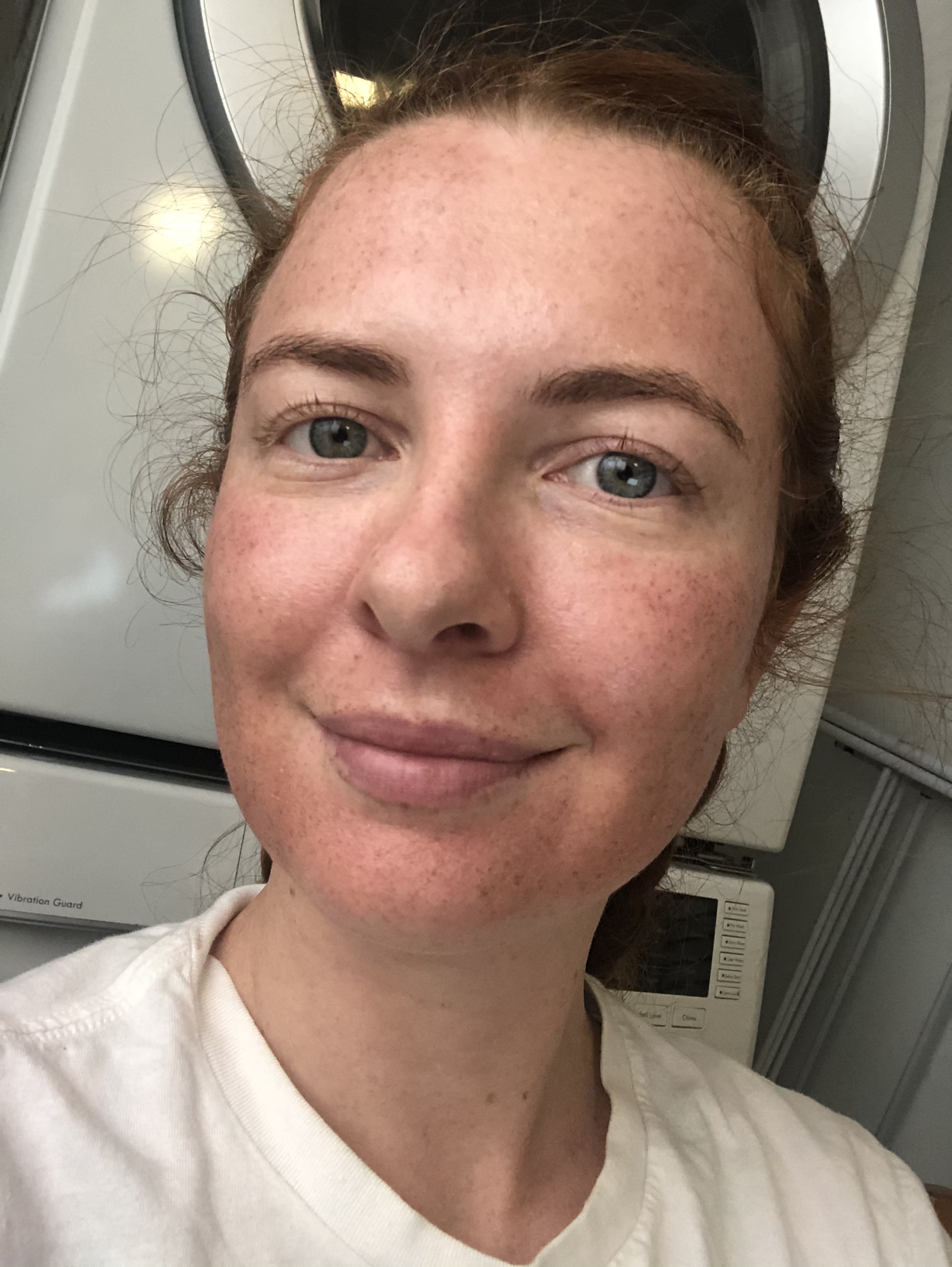 Two days after Halo treatment with visible MENDS.
