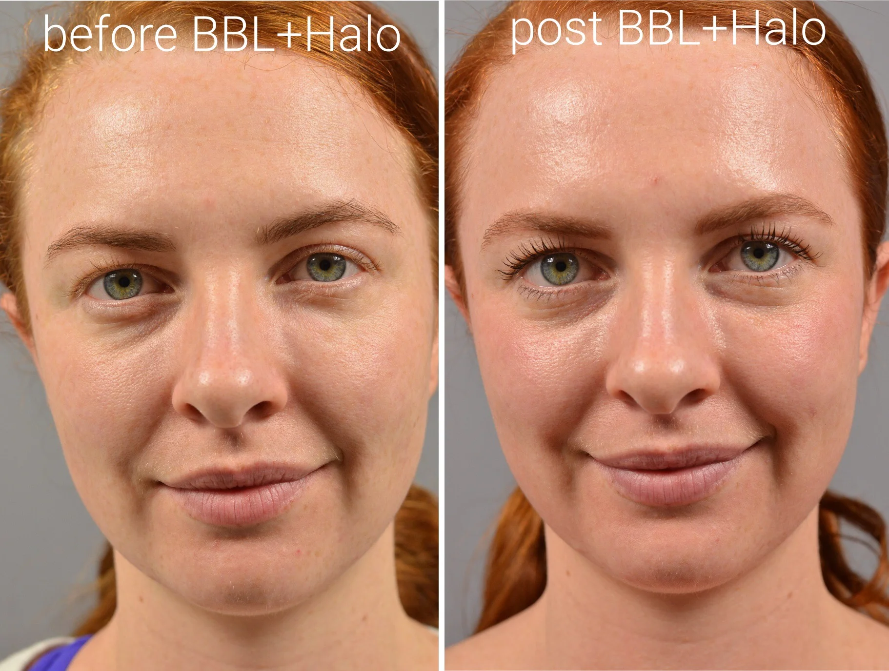 halo-laser-before-after.jpg