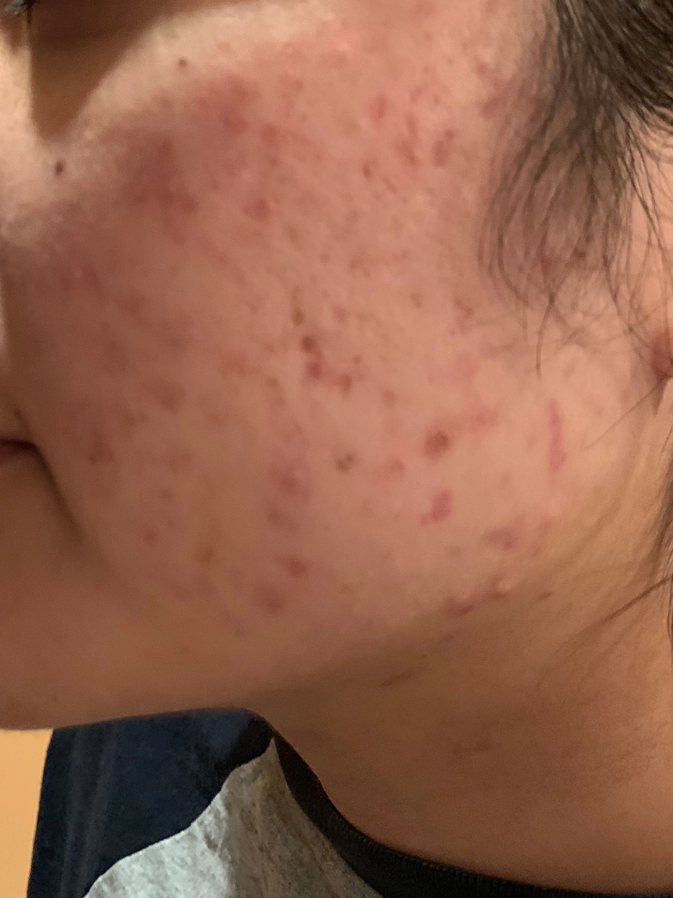Before beginning Accutane