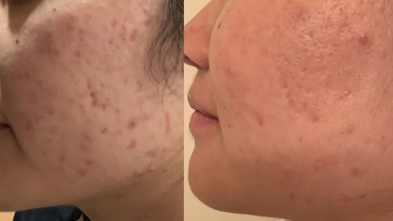 Is it Safe to Use Accutane for Acne?