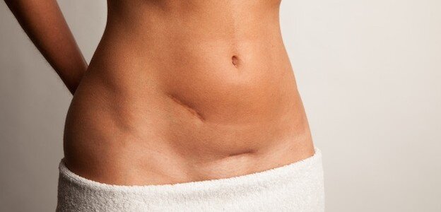 Woman with c section scars