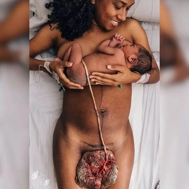 VAGINAL BIRTH AFTER C SECTION (VBAC)⠀⠀⠀⠀⠀⠀⠀⠀⠀​​​​​​​​
@venceslauthais shares 👉🏽 words fail me to describe everything this photo represents! It's my personal victory, it's my victory against the system, it's my rebirth. My normal delivery after two 