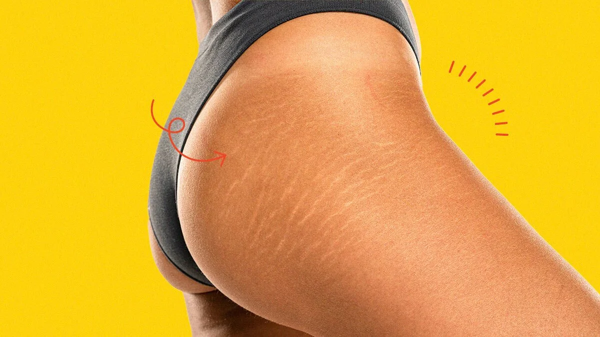 Scar and Stretch Mark Revision