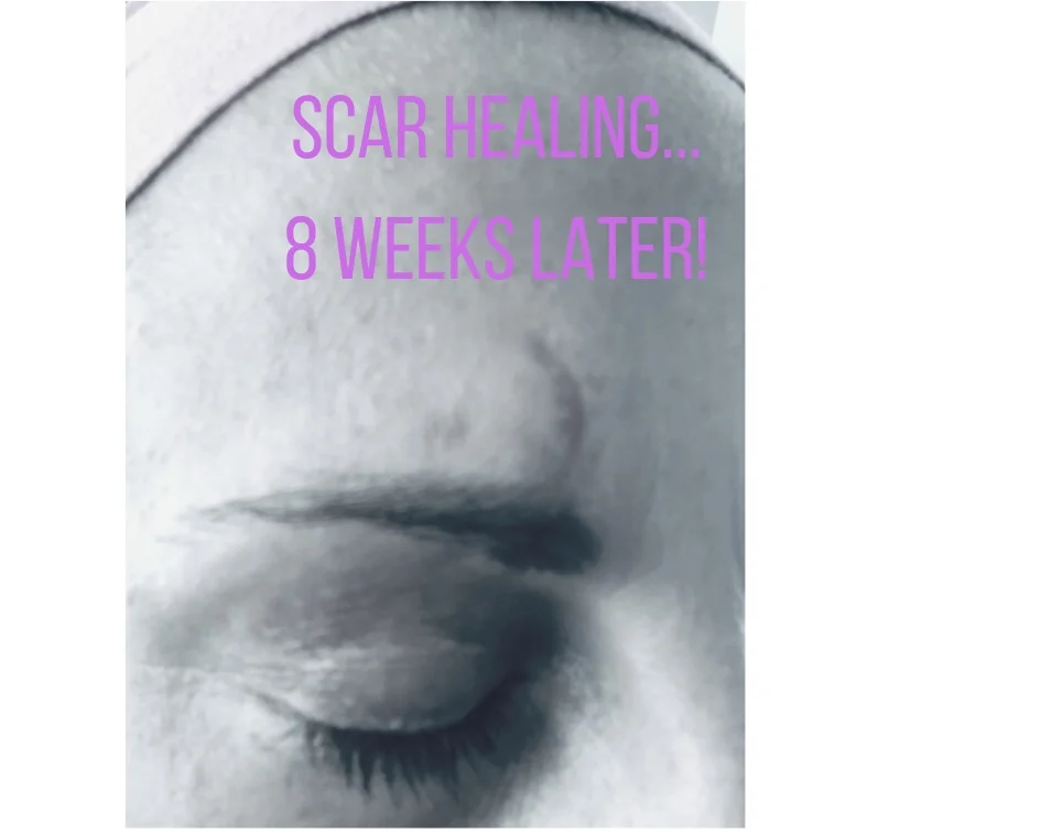 How to HEAL (your face) from Stitches and Scars