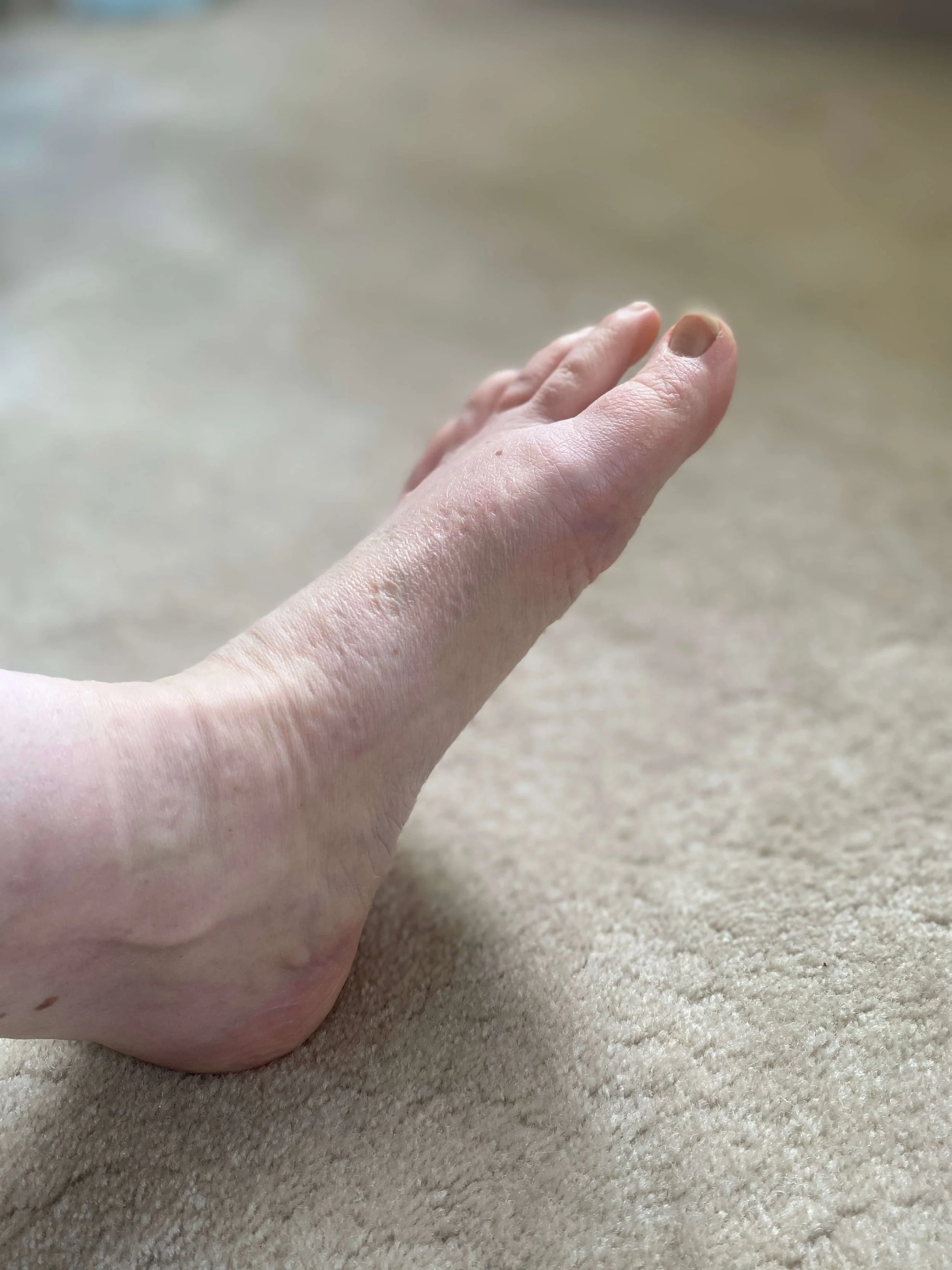 Why Your Plantar Fasciitis Still Isn’t Improving