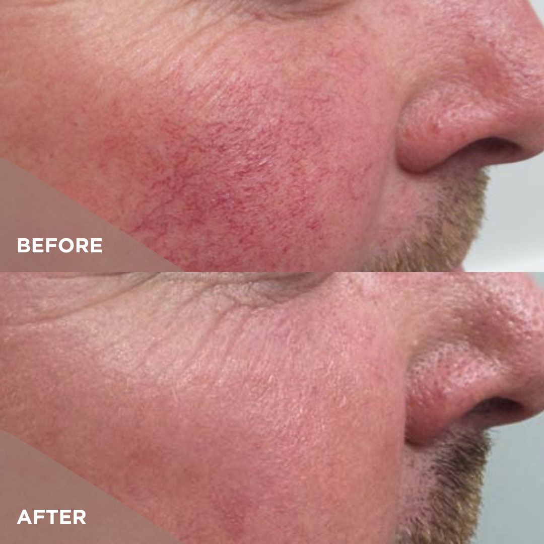 Results IPL 1 Tx Rosacea.png