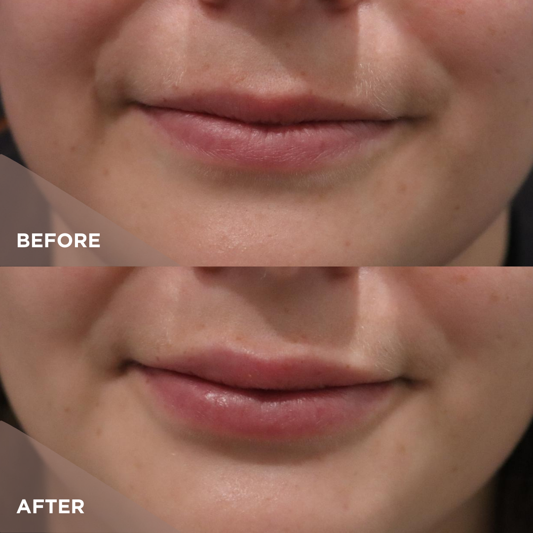 Results Filler 1_2 Syringe Lips.png