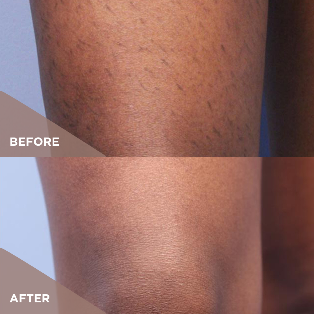 Results Laser Hair Legs Dark.png