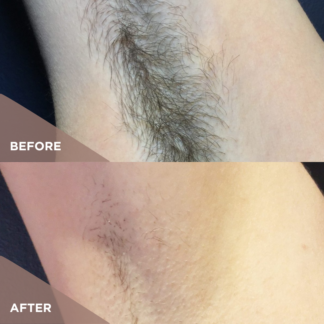 Results Laser Hair Underarm.png
