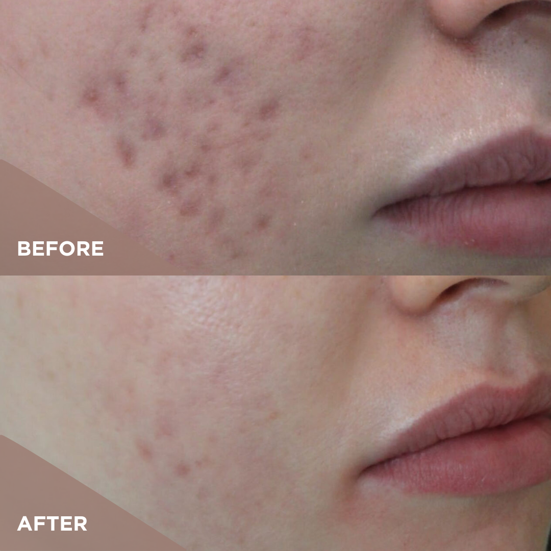 Results CO2 1Tx Acne Scars.png