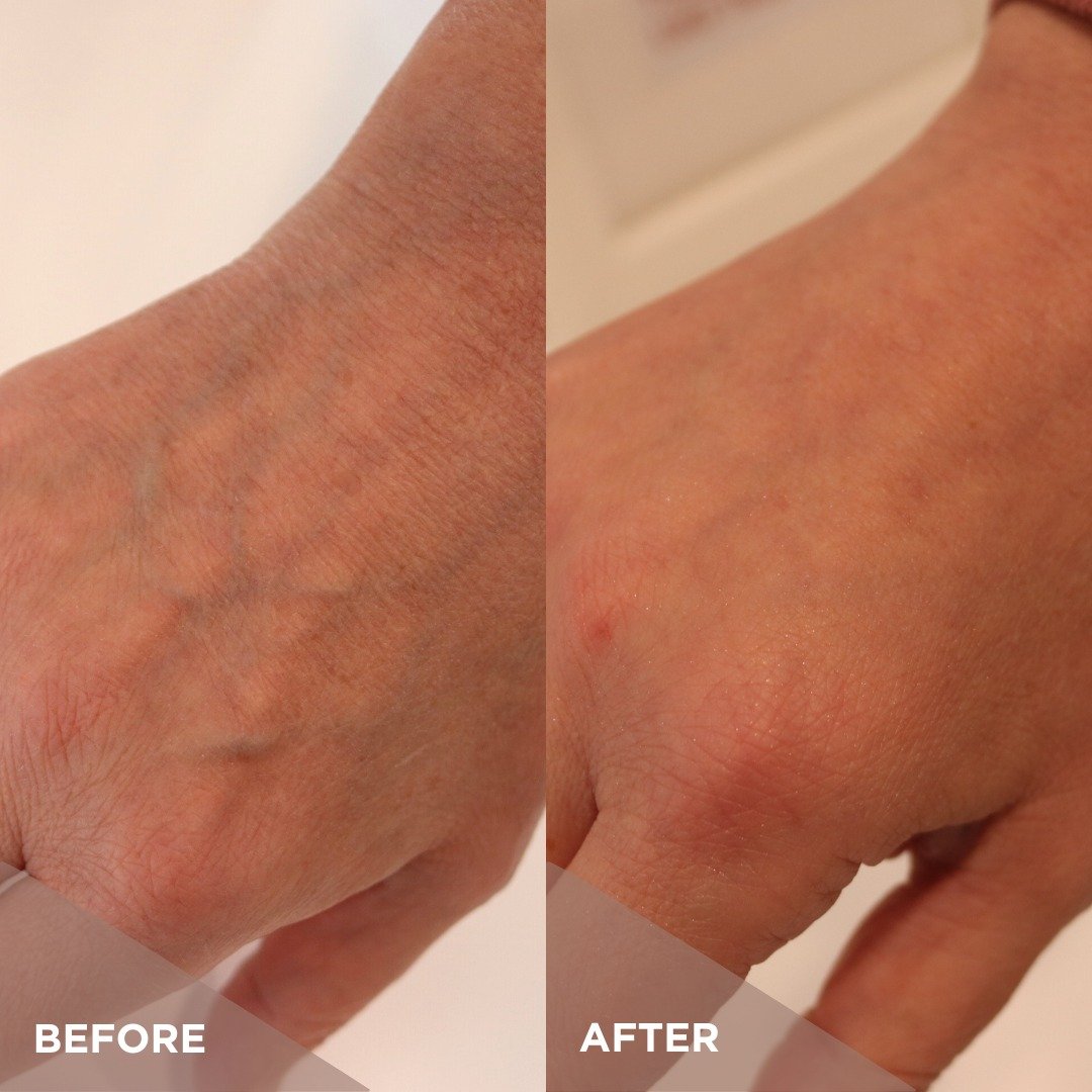 Ever considered filler for hands? A treatment of one to two syringes per hand will reduce the appearance of &lsquo;webbing&rsquo; and visible veins, and will result in younger-looking skin that naturally retains more moisture.