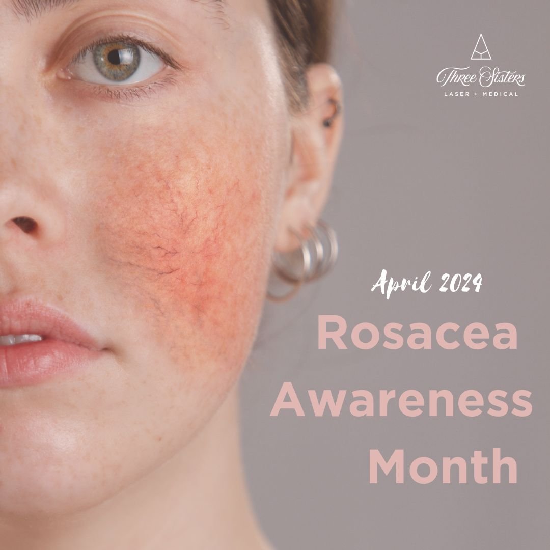 Rosacea is an inflammatory skin condition that impacts approximately 415 million people worldwide. 

Rosacea appears as redness and broken capillaries on the face, with or without pimples.
 
Treatments vary from patient to patient, from medical grade