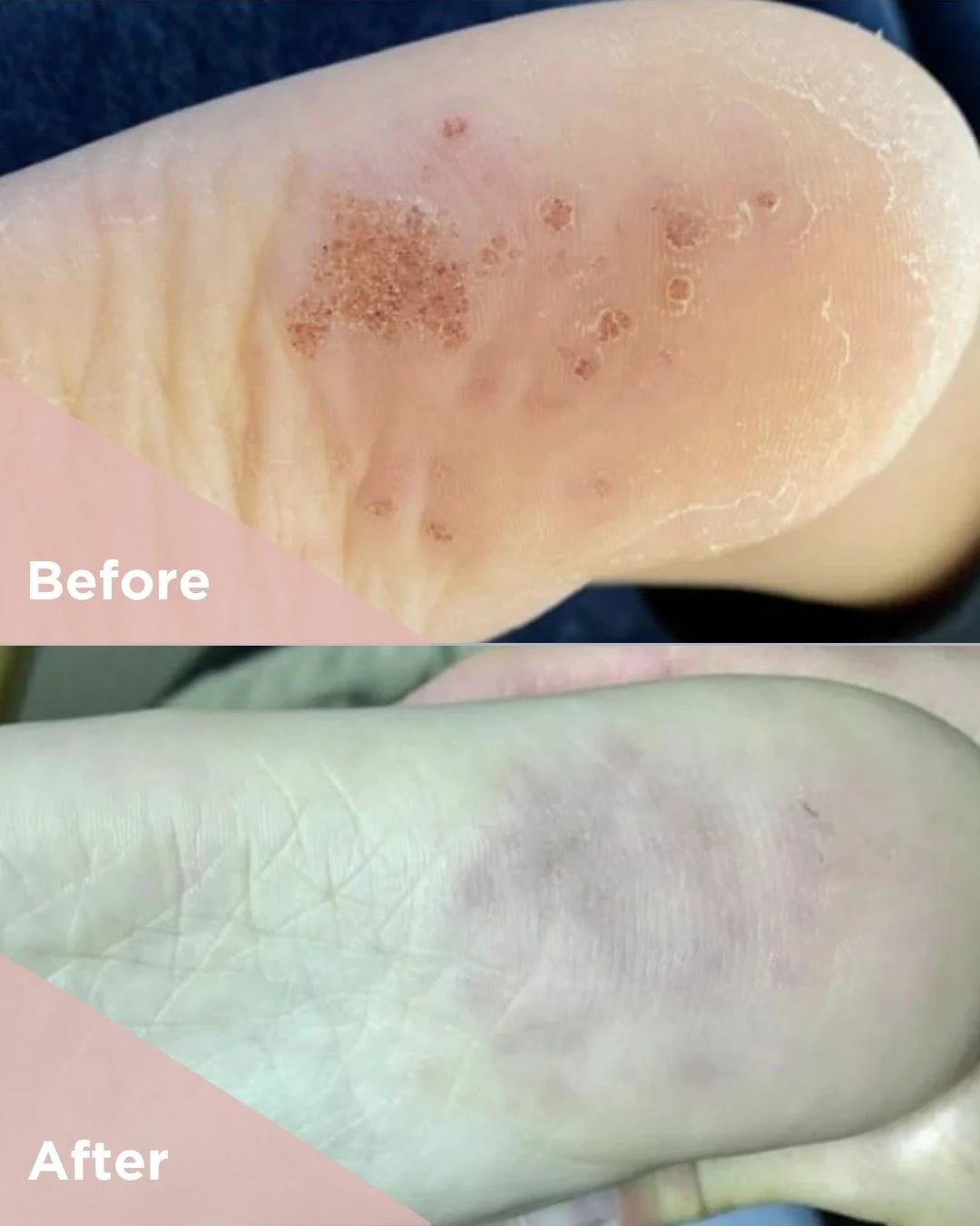 Swift treatment uses heat energy to gently heat infected wart tissue by a few degrees. That small temperature rise signals your immune system to recognize and respond to the wart virus.

Instead of cutting or burning away tissue, this approach works 