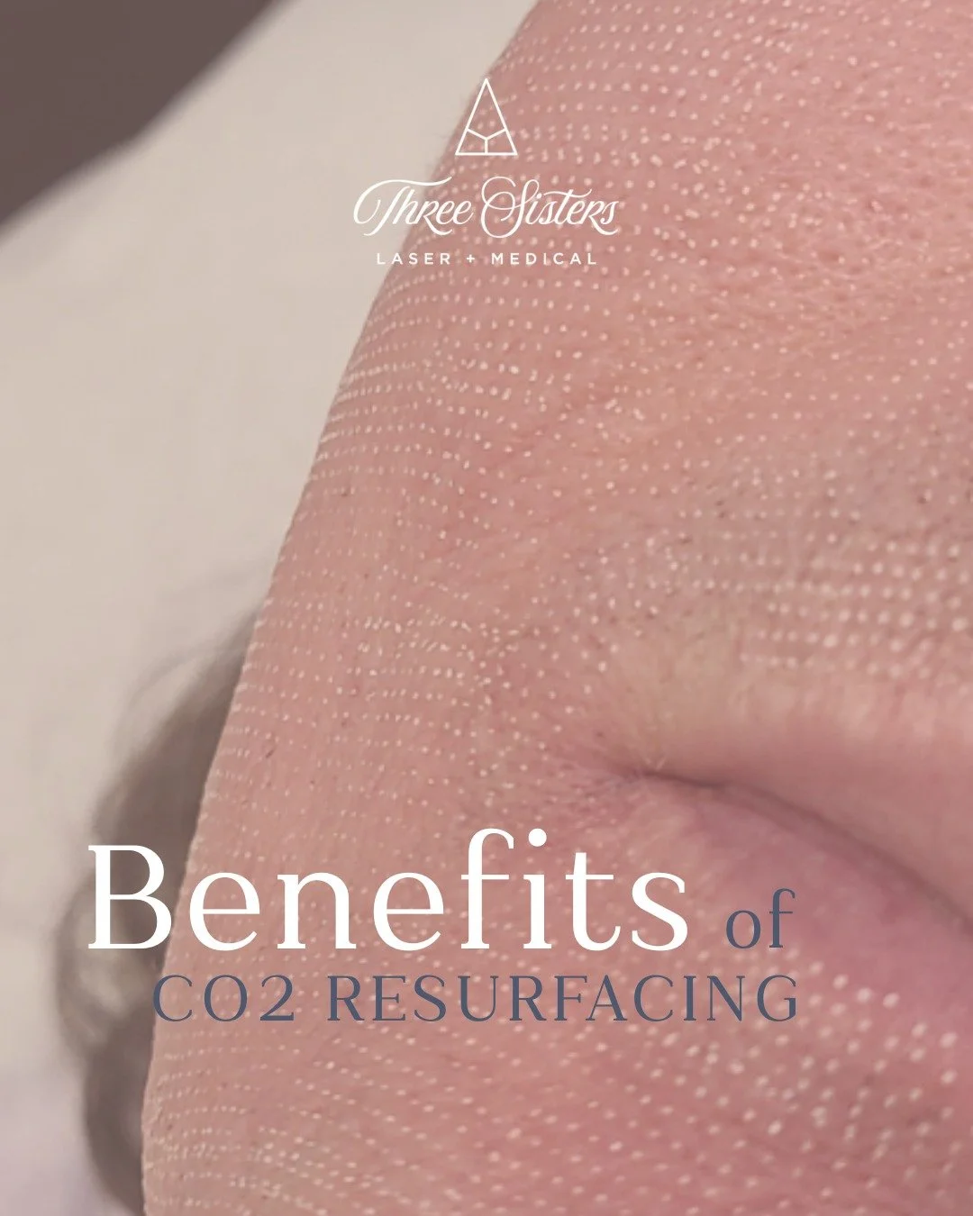 CO2 laser resurfacing uses fractional carbon dioxide energy to gently remove supreficial damaged skin + texture, stimulating natural collagen + elastin production for smoother, healthier looking skin ✨

Laser BOGO is on now through March 31&mdash;boo