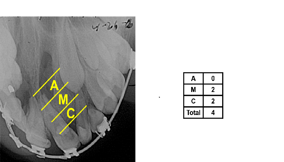 Bone Graft Outcomes