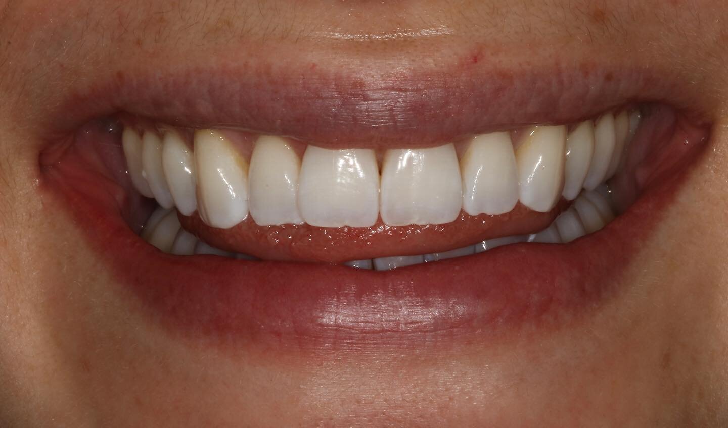 Brightening up for spring. After|Before. 🌷
.
.
.
#teethwhitening #vancouverdentist #smile #whiteteeth #vancity #oralhealth #selfcare