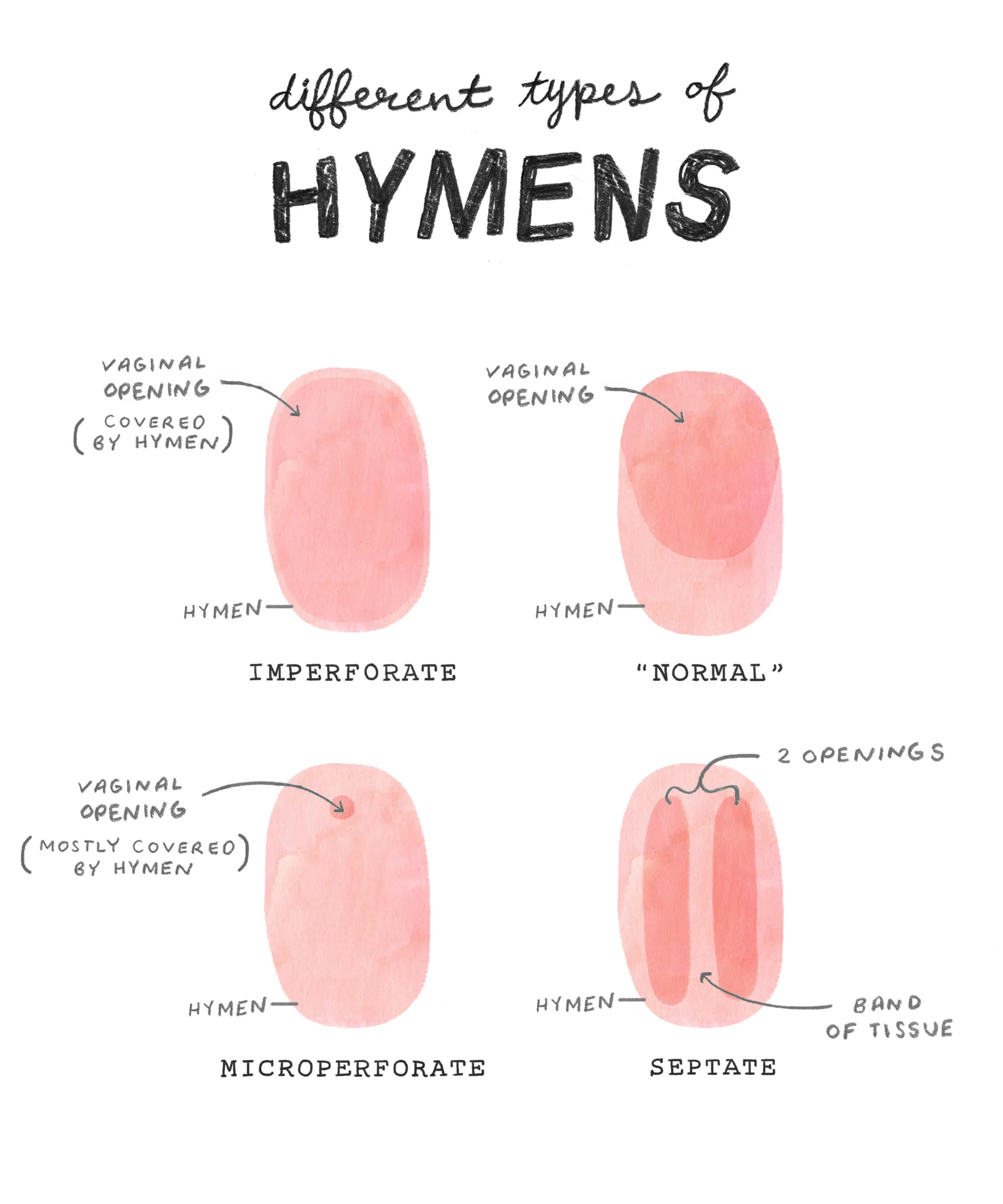 Example Of Hymen tampon fiasco + hymens — The Cheeky Blog