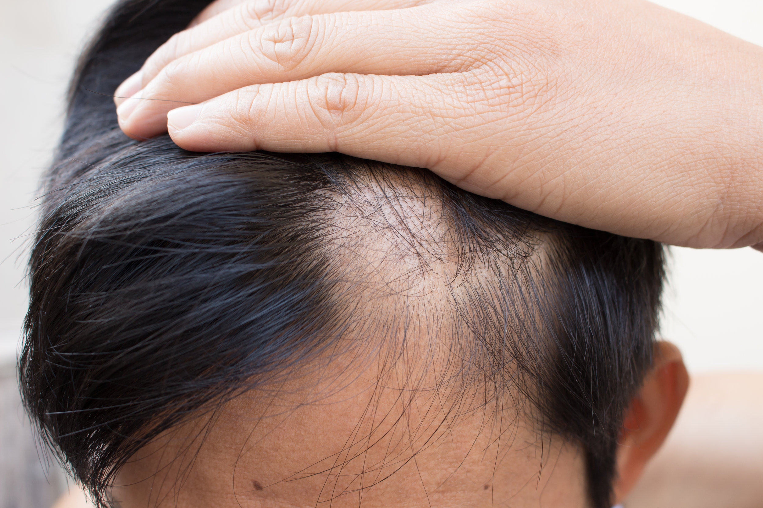 Hairloss — Twin Cities Dermatology Center
