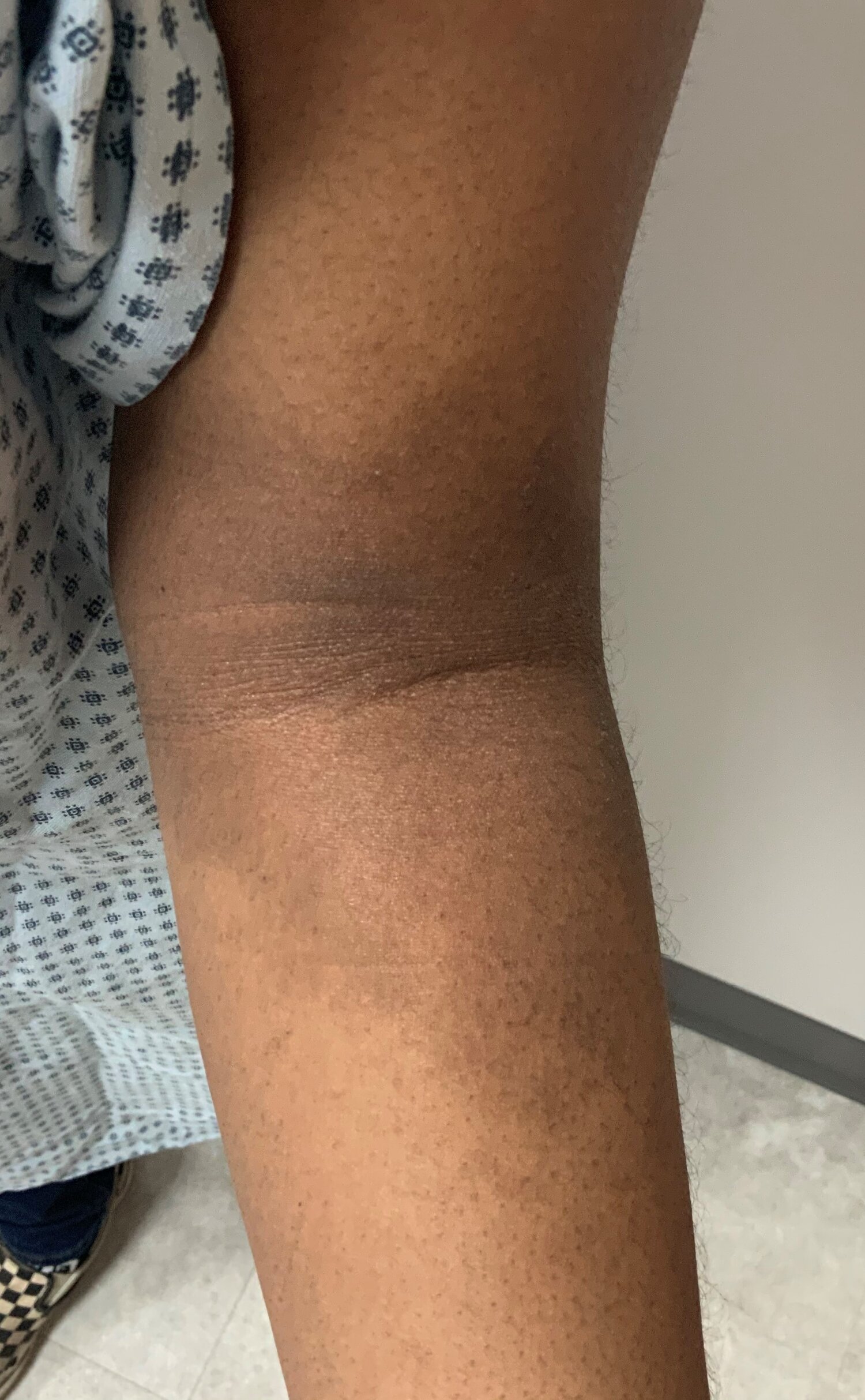 Eczema — Twin Cities Dermatology Center Eczema — Twin Cities Dermatology Center