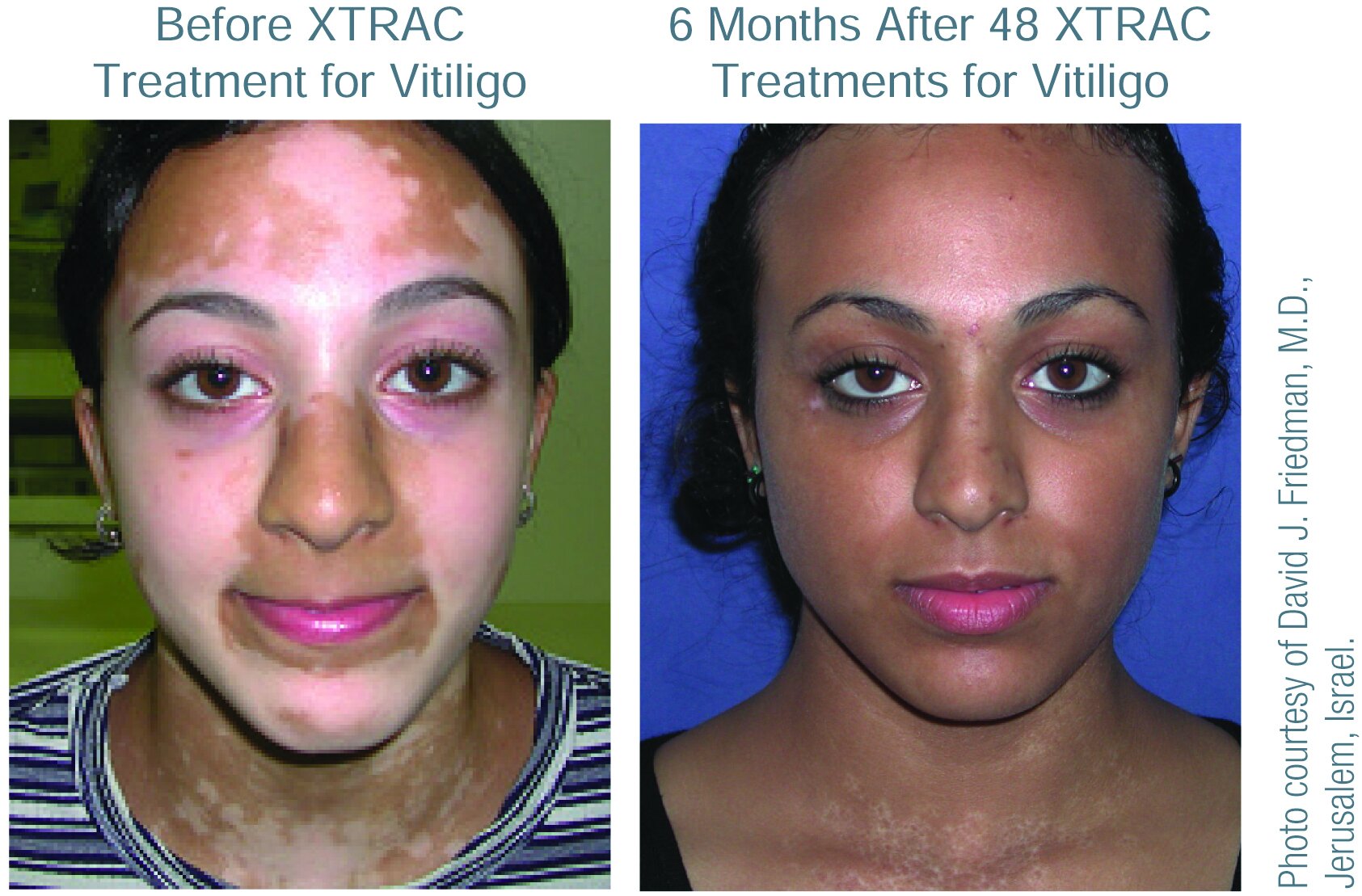 Treatment vitiligo Updates and