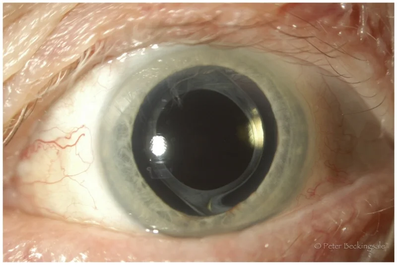 Cataract-2.jpg
