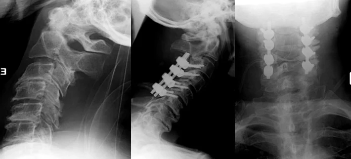 posterior_fusion