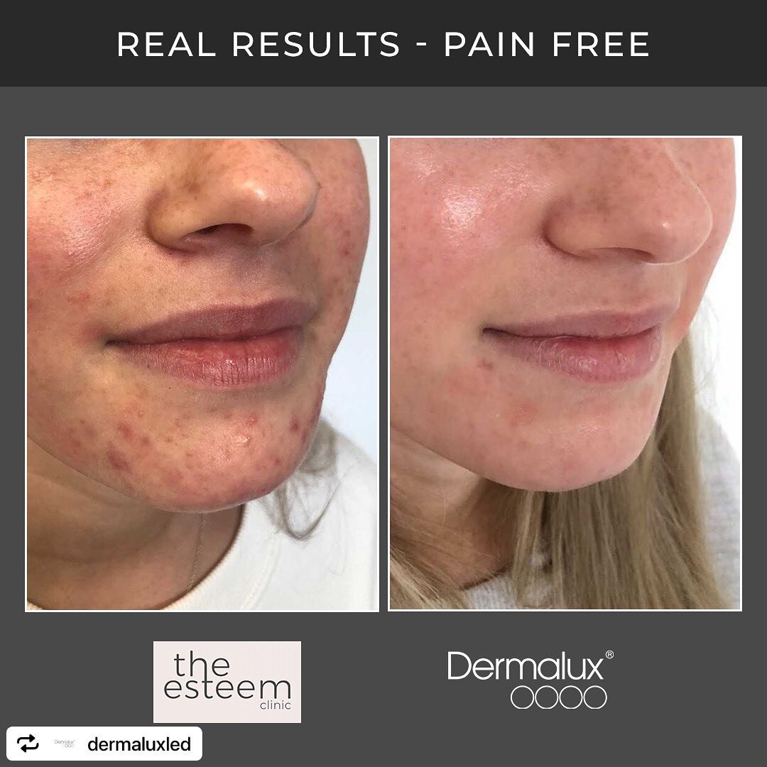 Thank you to @theesteemclinic for sharing these fantastic acne results with Dermalux. 

The protocol detailed below included 6 Flex MD treatments using our powerful and clinically proven 415nm Blue light. 

&quot;Well these skin results speak for the