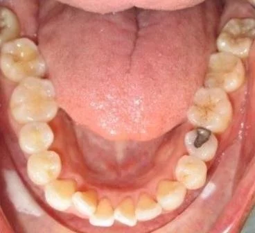 Invisalign K3 before.jpg