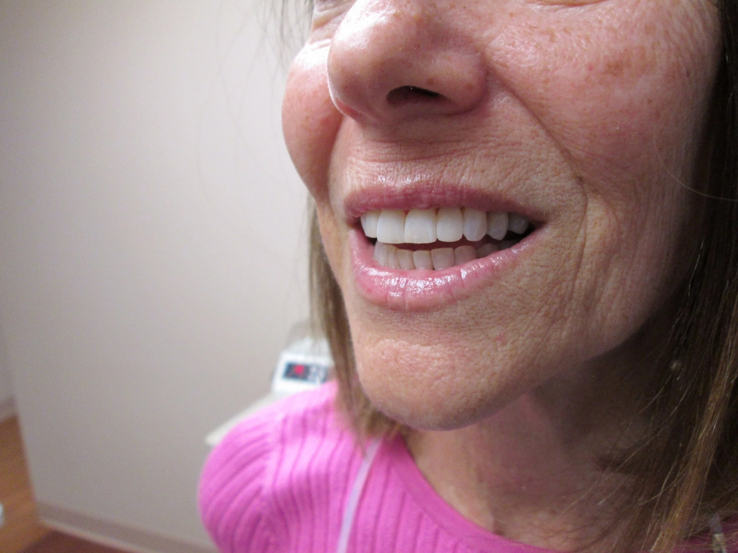 composite veneers to reshape teeth, gap closure on front 4 teeth after (2).jpeg