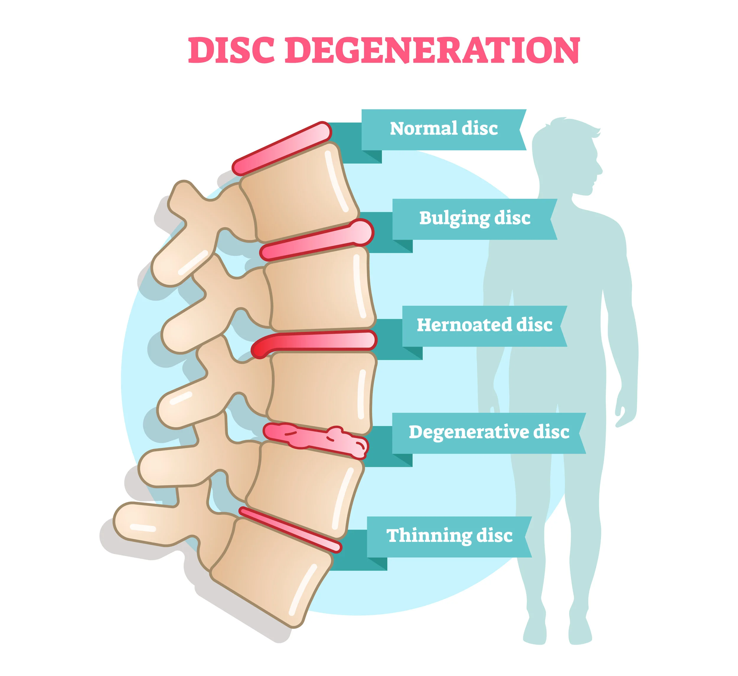 Discogenic cervical and lumbar pain 